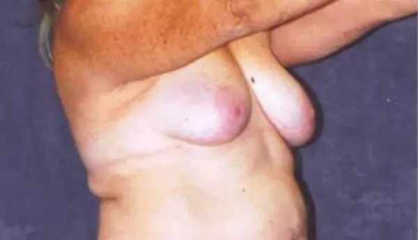 Breast Augmentation  Before & After Image
