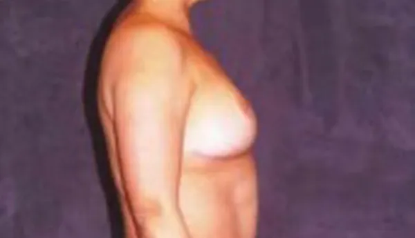 Breast Augmentation  Before & After Image