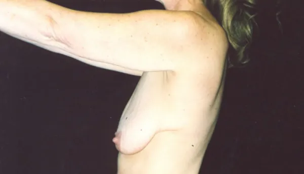 Breast Augmentation  Before & After Image