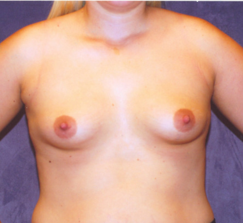 Breast Augmentation  Before & After Image