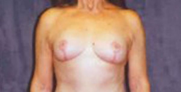 Breast Augmentation  Before & After Image