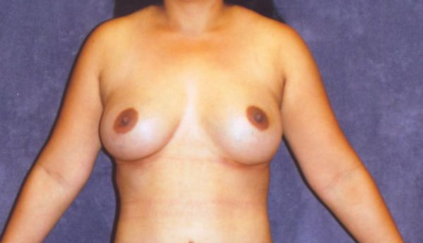 Breast Augmentation  Before & After Image