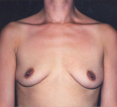 Breast Augmentation  Before & After Image