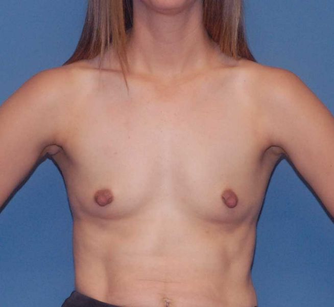 Breast Augmentation  Before & After Image