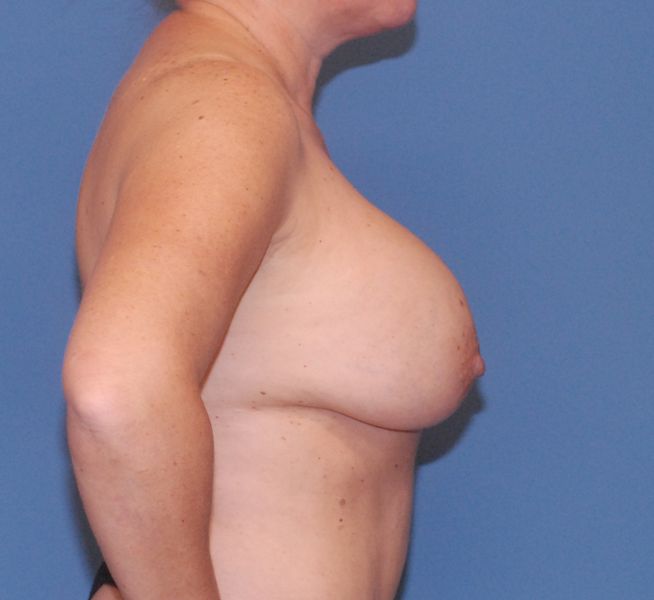 Breast Corrections & Revisions Before & After Image