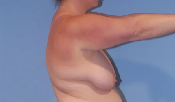 Breast Lift Before & After Image