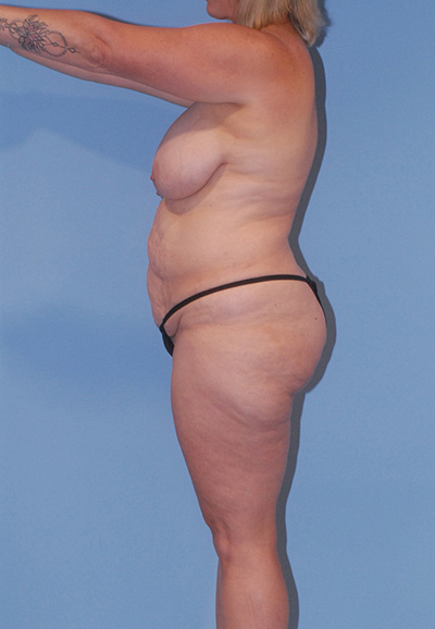 Breast Lift Before & After Image