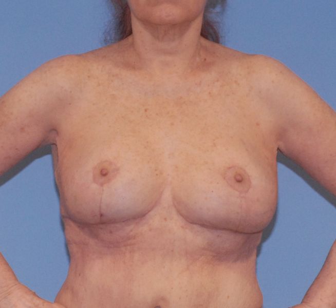 Breast Reduction And Lift Before & After Image