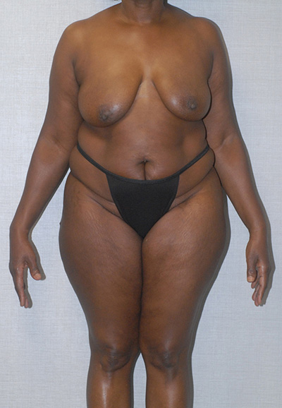 Breast Reduction And Lift Before & After Image