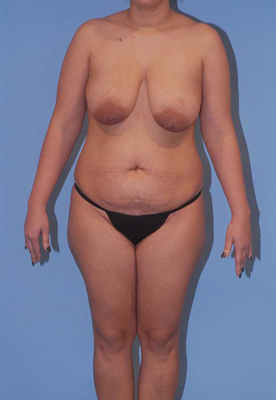 Breast Reduction And Lift Before & After Image
