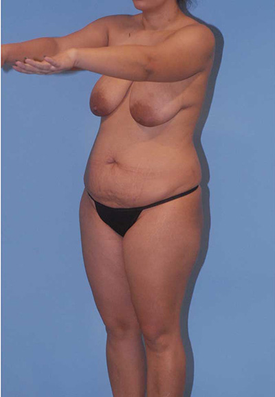 Breast Reduction And Lift Before & After Image