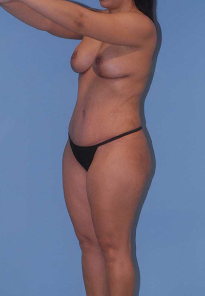 Breast Reduction And Lift Before & After Image