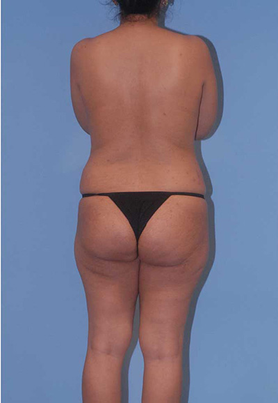 Breast Reduction And Lift Before & After Image