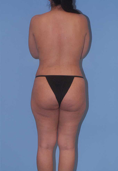 Breast Reduction And Lift Before & After Image