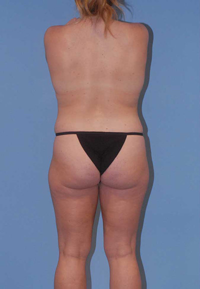 Breast Reduction And Lift Before & After Image