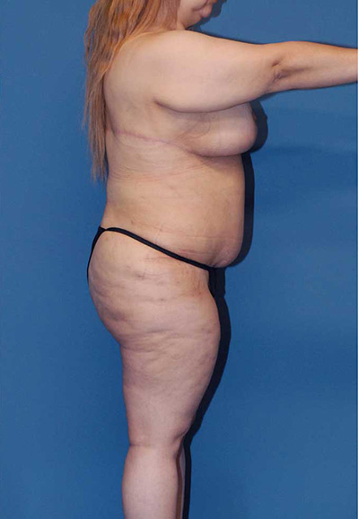 Breast Reduction And Lift Before & After Image
