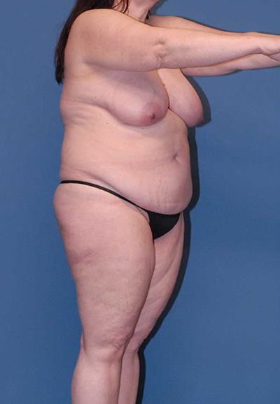 Breast Reduction And Lift Before & After Image