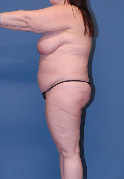 Breast Reduction And Lift Before & After Image