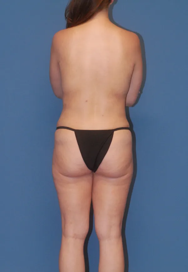 Fat Grafting to Breast Before & After Image