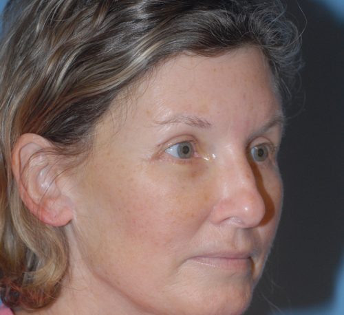 Blepharoplasty Before & After Image