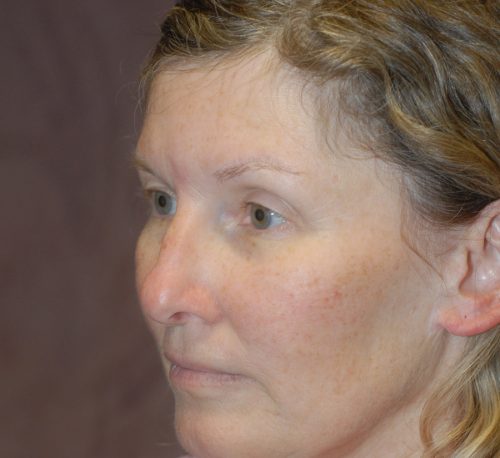 Blepharoplasty Before & After Image