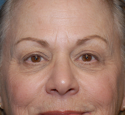 Blepharoplasty Before & After Image