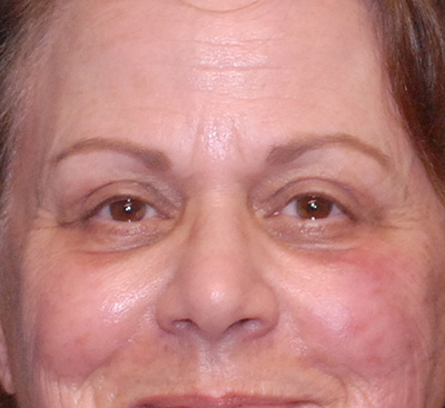 Blepharoplasty Before & After Image