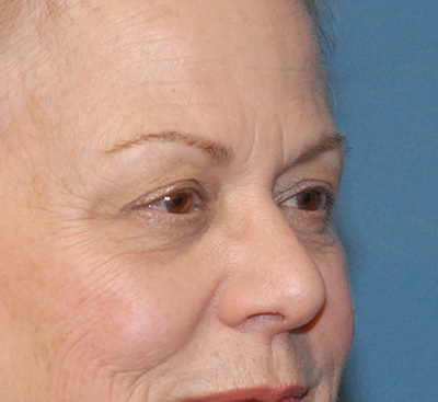 Blepharoplasty Before & After Image