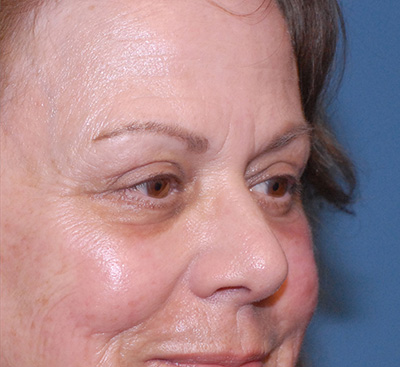 Blepharoplasty Before & After Image