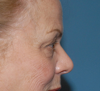 Blepharoplasty Before & After Image