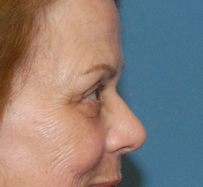 Blepharoplasty Before & After Image