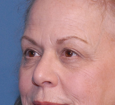 Blepharoplasty Before & After Image