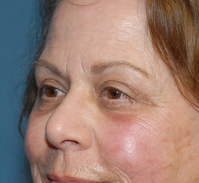 Blepharoplasty Before & After Image