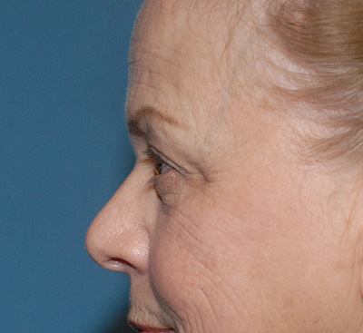 Blepharoplasty Before & After Image