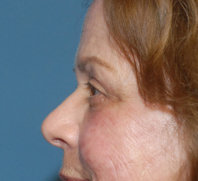 Blepharoplasty Before & After Image