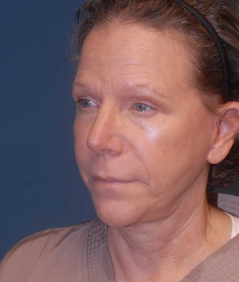 Brow Lift Before & After Image