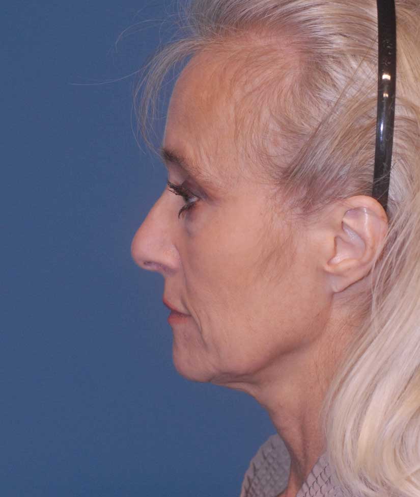 Brow Lift Before & After Image