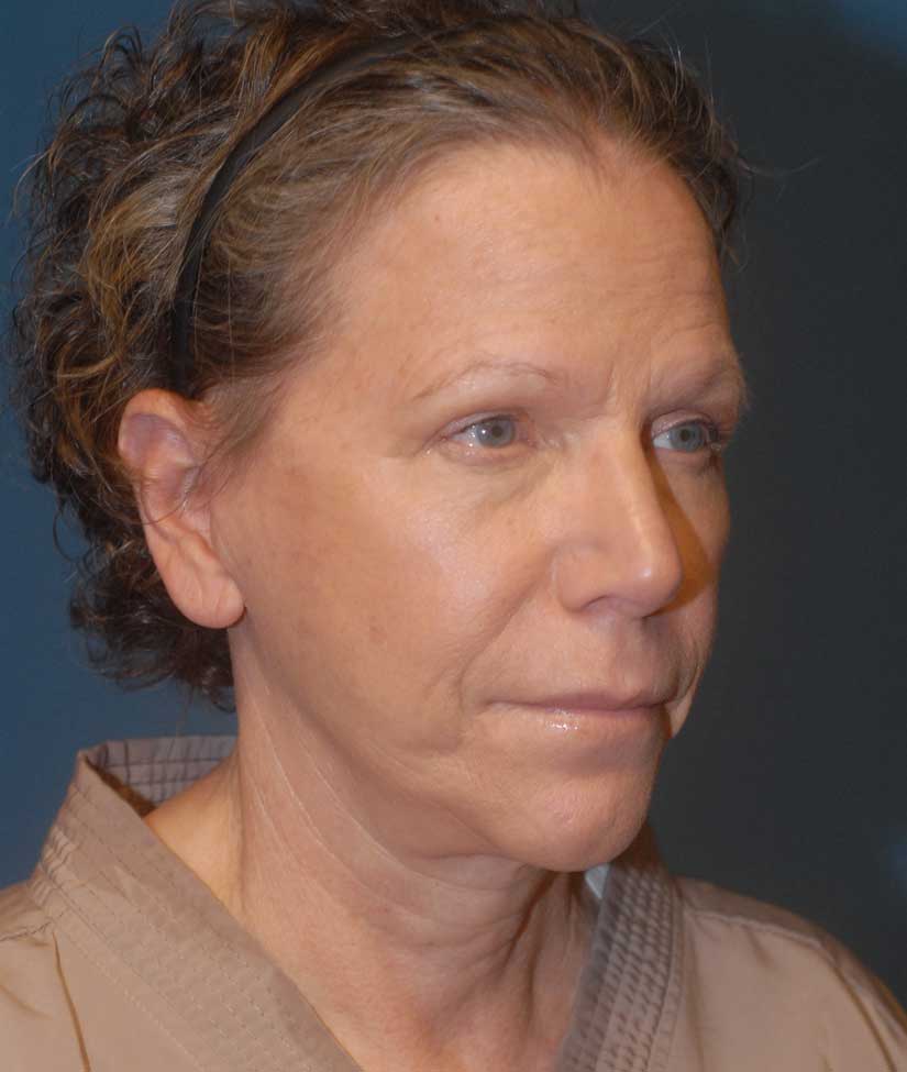 Facelift Before & After Image