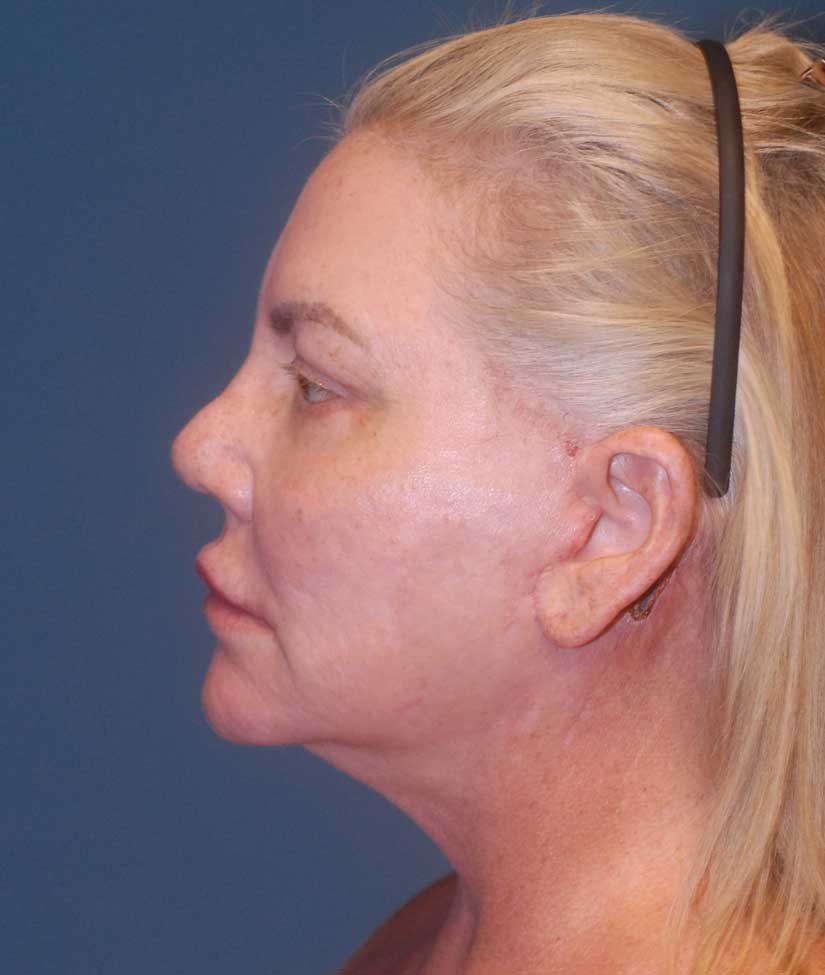 Facelift Before & After Image