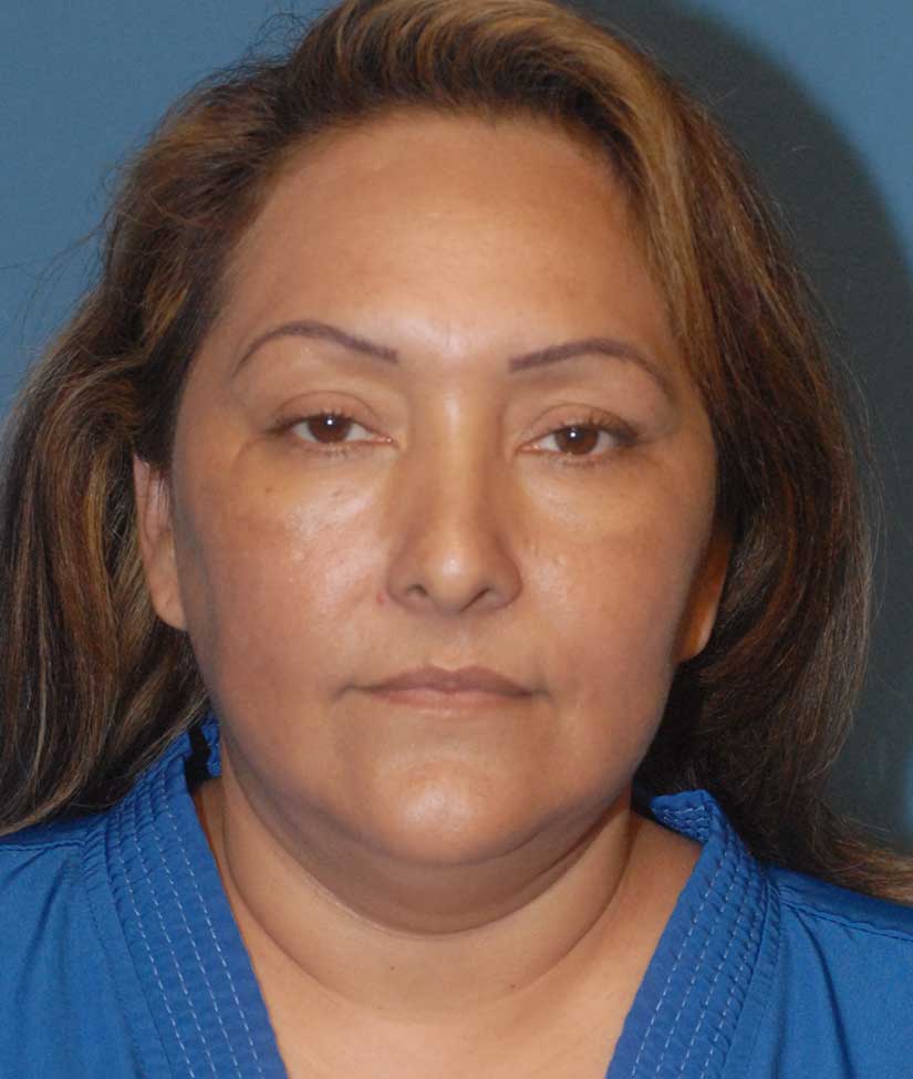 Facelift Before & After Image
