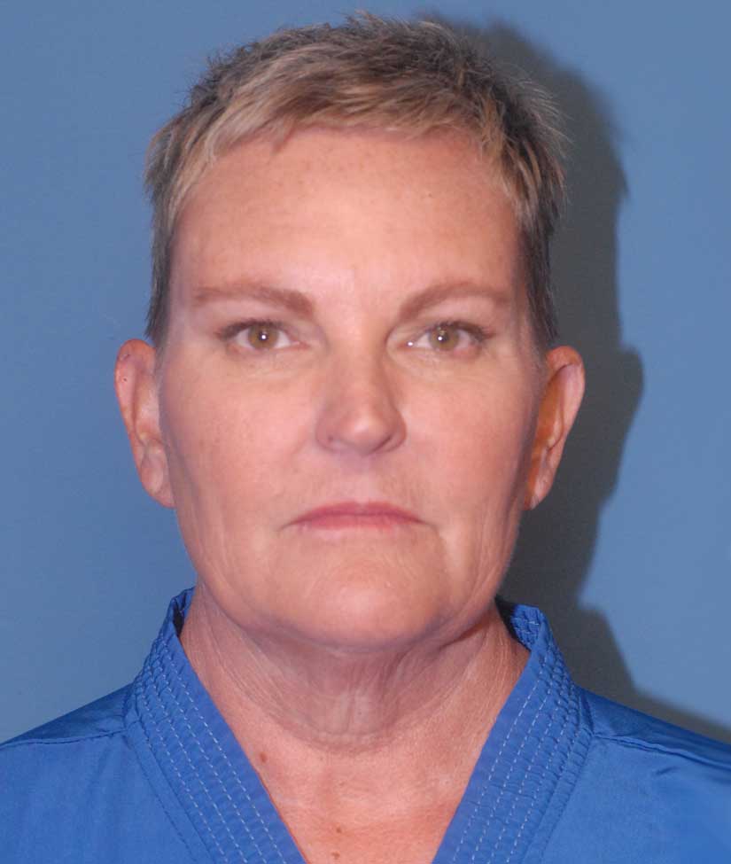 Facelift Before & After Image