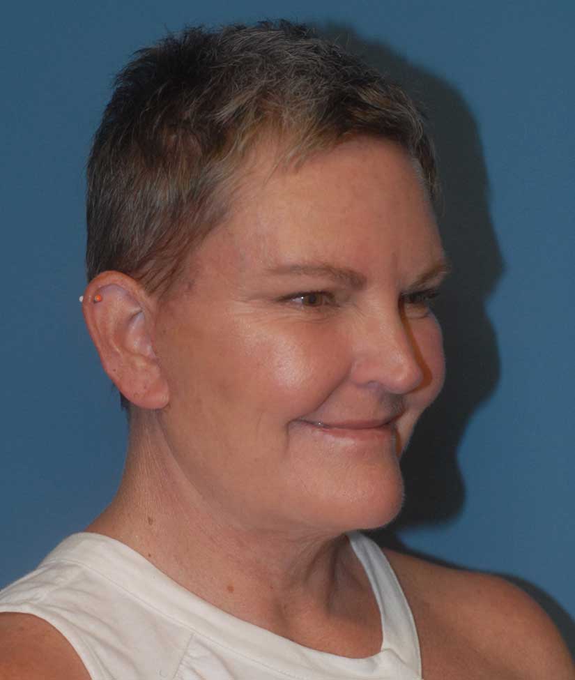 Facelift Before & After Image