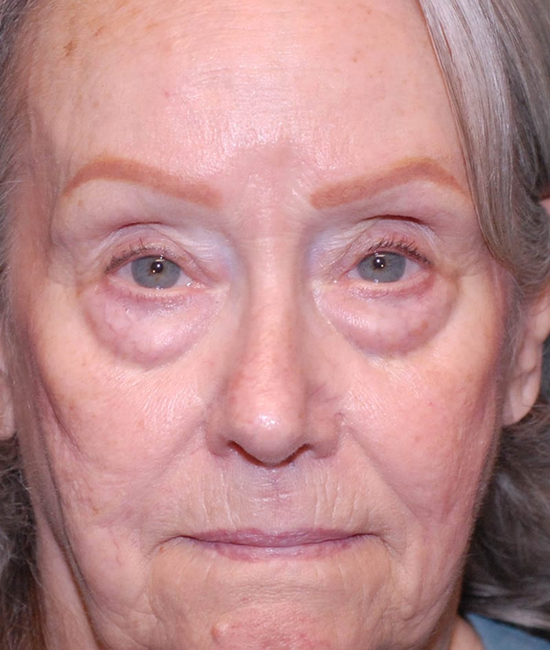Facelift Before & After Image