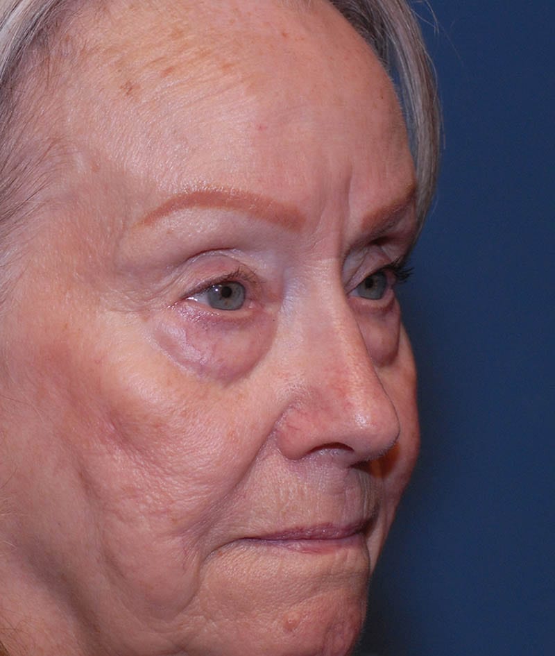 Facelift Before & After Image