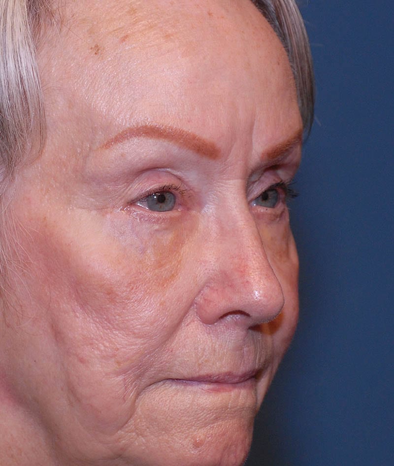 Facelift Before & After Image