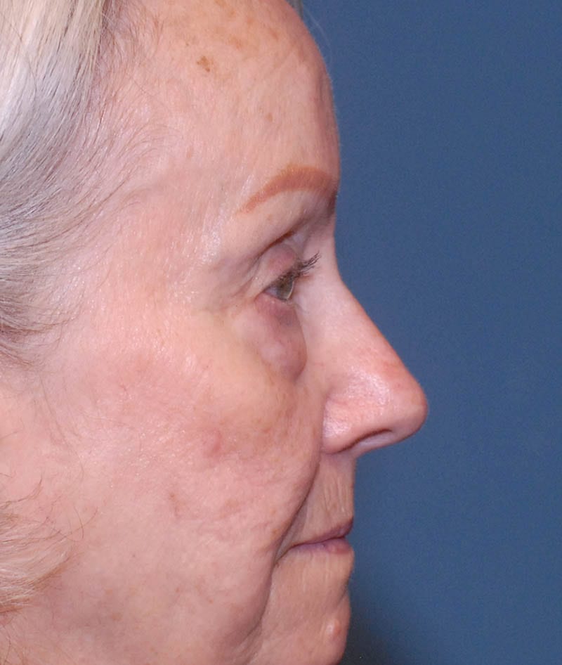Facelift Before & After Image