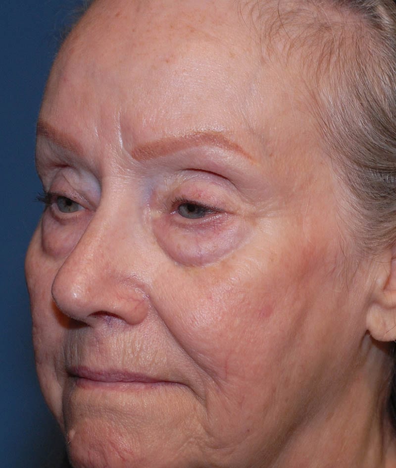 Facelift Before & After Image