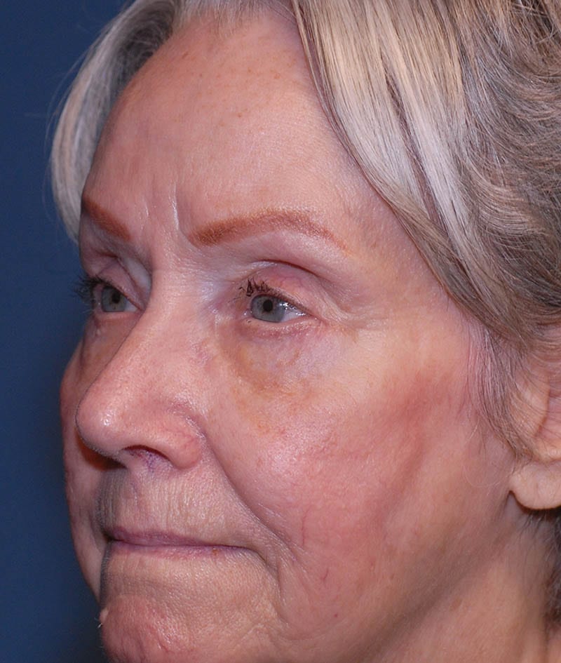 Facelift Before & After Image