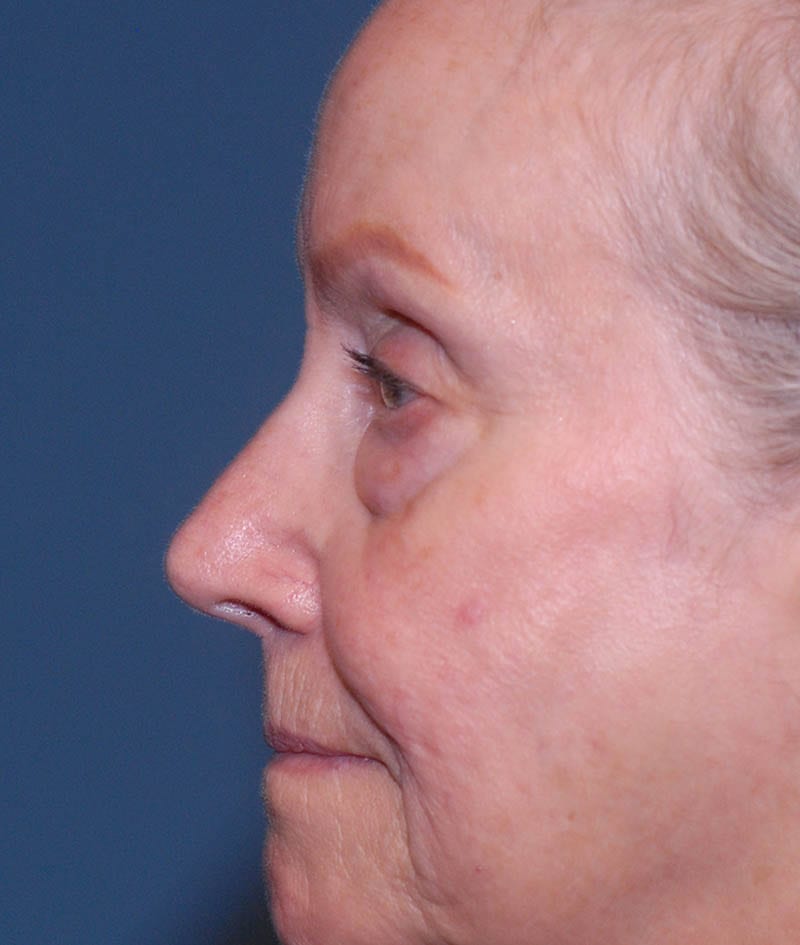 Facelift Before & After Image