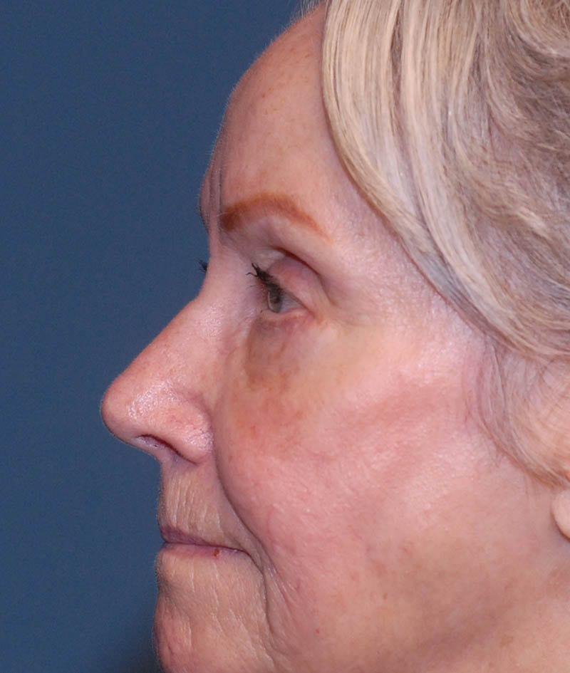 Facelift Before & After Image
